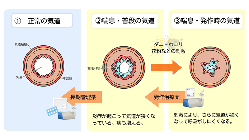 気管支喘息画像